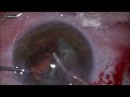 Using dr sohel khan s prechopper from india on grade 3 cataract migs vitreocutter trabeculotomy
