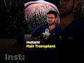 Hair Transplant Without Taking a Break From Work!