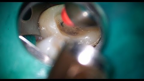 Non-visible broken file removal with XP Finisher/XPフィニッシャーによる見えない破折器具除去