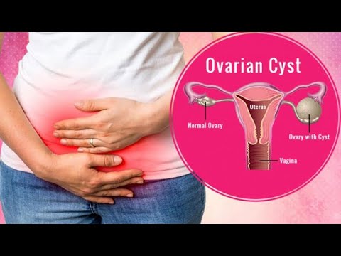 Ovarian cyst- causes, treatment | নারীদের ওভারি সিস্ট কি, কেন হয় এবং করণীয়