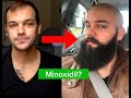 Minoxidil Journey - A Comprehensive Overview