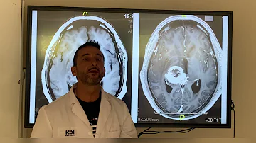 ¿Qué aspecto tienen las lesiones cerebrales en una resonancia magnética?