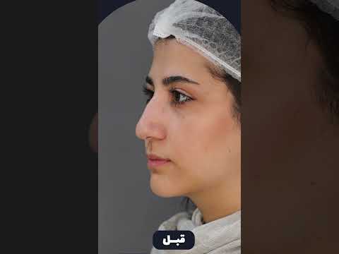 رضایت لیفت بینی با نخ درکمتر از ده دقیقه لیفت بینی با نخ