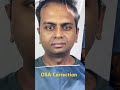 OSA Correction In INDIA - How Snoring Is Cured and facial balance improved with OMFS Surgery