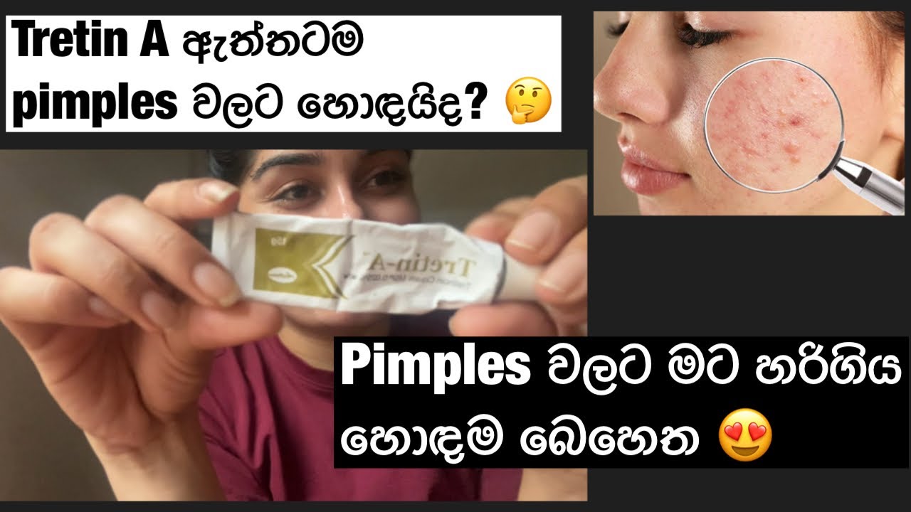 Tretin A හොඳඳ? | මගෙ මූනට හරිගිය බෙහෙත| Retinol for pimples