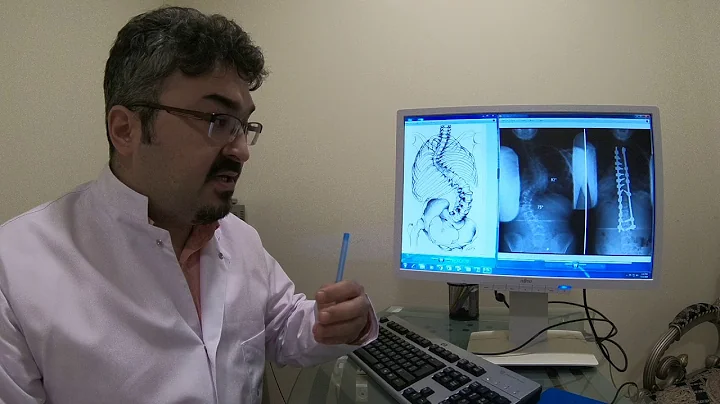 Do adult patients with scoliosis need surgery?