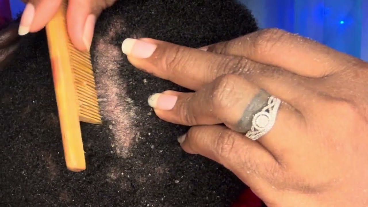 ASMR scalp scratching he slept all the way #asmr #asmrscratching 