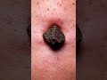 🪨 Hard as a Rock! (Old Blackhead) #crunchy  #macroasmr #satisfying #blackheadcaique #skincare #relax