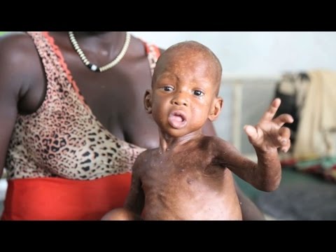 Le Soudan du Sud au bord de la famine  AFP Reportage
