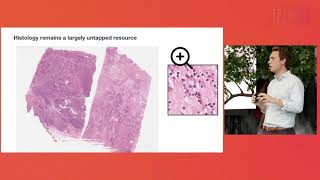 Making Precision Medicine a Reality with Federated Learning I TechBBQ 2021