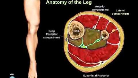 Compartment Syndrome Animation
