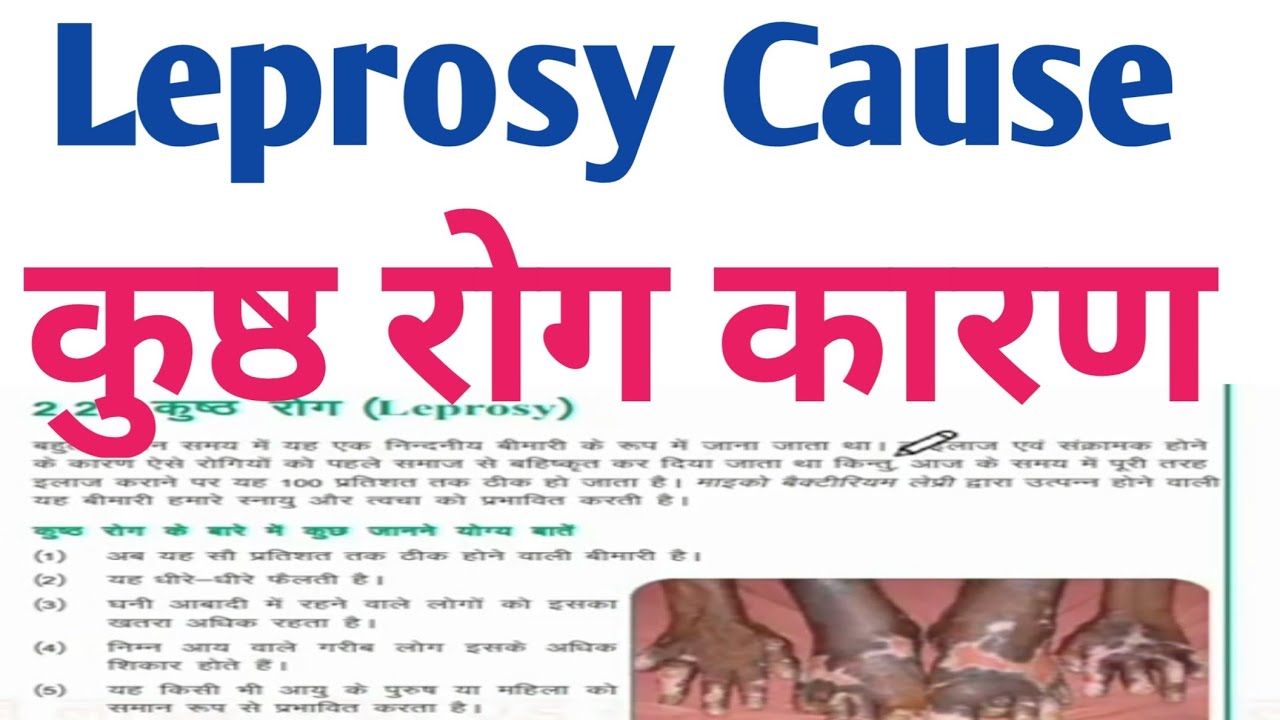 Leprosy Cause Leprosy Disease Leprosy Disease How Leprosy cause leprosy disease leprosy disease how