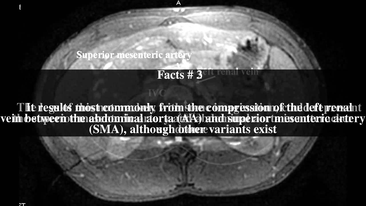 Nutcracker syndrome Top 5 Facts YouTube