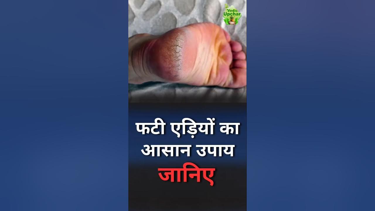 How To Fix Deep Cracked Heels Naturally Vedic Upchar Anil Bansal how-to-fix-deep-cracked-heels-naturally-vedic-upchar-anil-bansal
