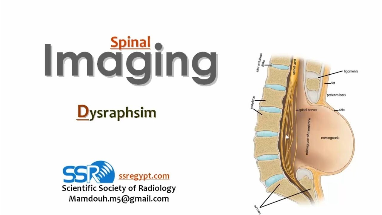 18 Pediatric imaging Spinal dysraphism  TEC  Prof  Mamdouh Mahfouz