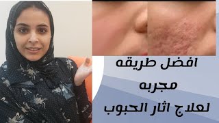 افضل طريقه للتخلص من أثار حب الشباب في الوجه في اقل من اسبوع