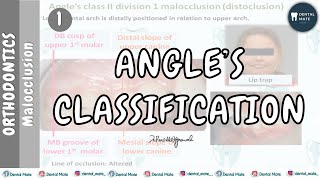 Angle's Classification of Malocclusion | Dr Paridhi Agrawal