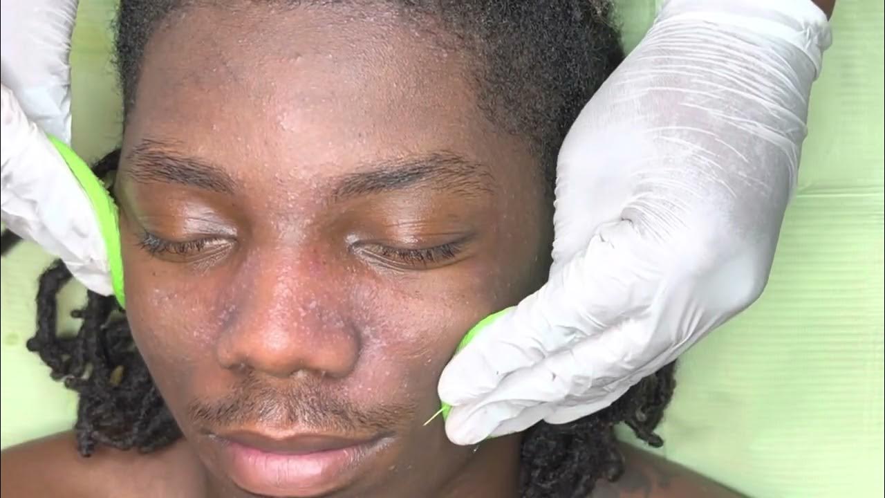 FROSTING VS BLANCHING facial 9 update 1 YouTube