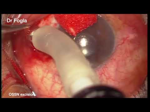 OSSN Excision Biopsy