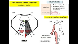 HEMIPLEJÍAS ALTERAS TRONCALES (SINDROMES ALTERNOS)