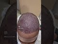 Hair transplant surgery in lahore Pakistan by dr Saleem