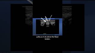 #ultrasound Guided Interventions: Cases (Trigger Finger Injection)