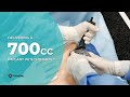 Delivering a 700cc implant with stingray