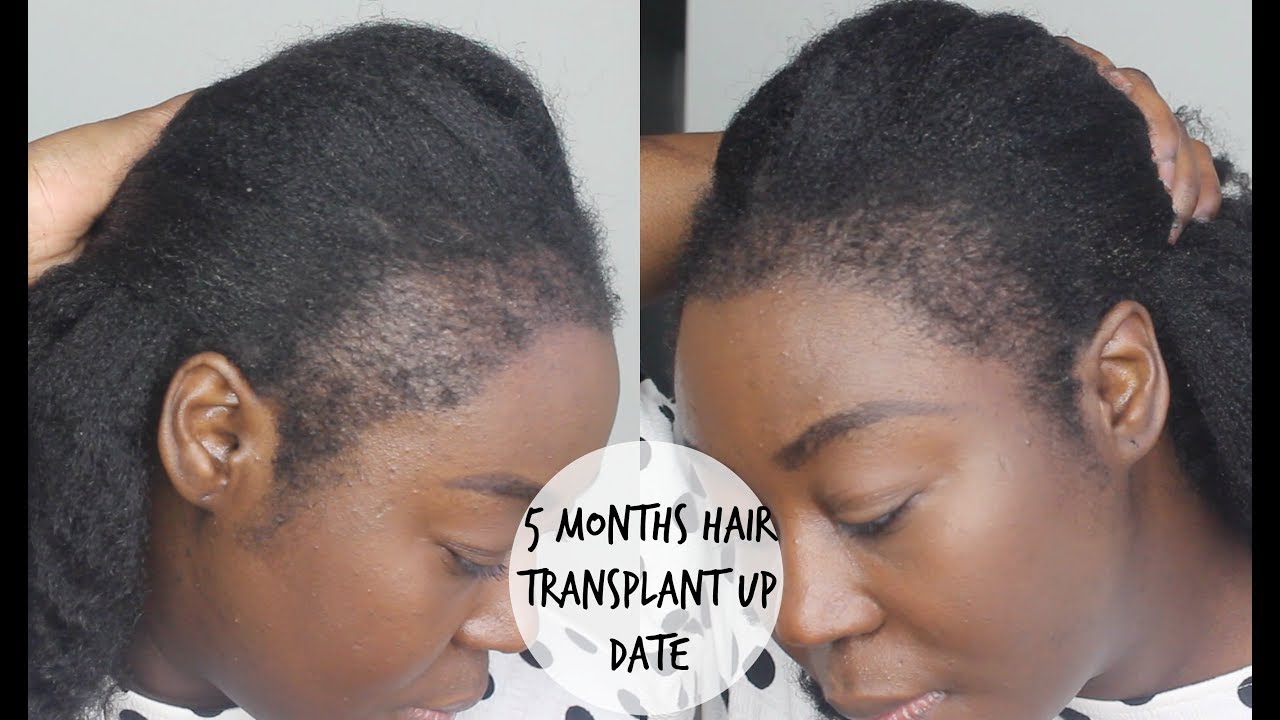 Hair Transplant After 4 Months What To Expect