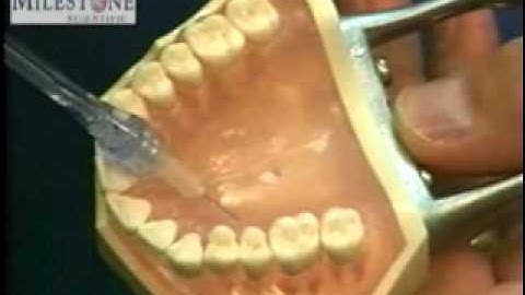 AMSA - Anterior Middle Superior Alveolar Block Injektion