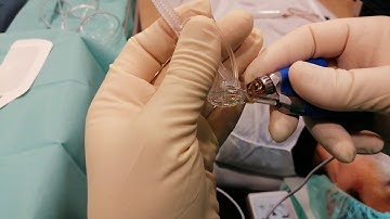 Assemblying the Moria One-Use plus microkeratome.