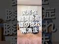 【変形性膝関節症】膝の痛みの原因は膝の捻れ？1日5分でできる変形性膝関節症改善リハビリ#shorts