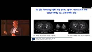 Dr. Mark Schinsky  Discusses THA's in Hip Dysplasia