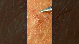 Hidden ingrown hair removal#ingrownhair#satisfying#hairproblem#closeup#shorts#hairissue#picker