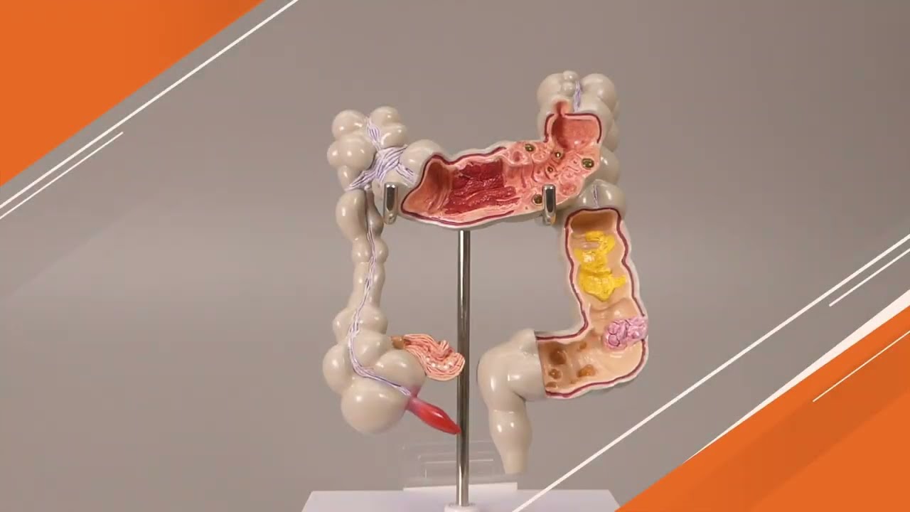 Colon Model With Common Pathologies 3340 Colon Anatomy