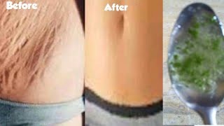 How To Remove Stretch Marks Faster Naturally At Home / Julia Beauty Recipes