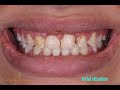 A challenging case : Fixing her smile 5 days before her wedding in one visit