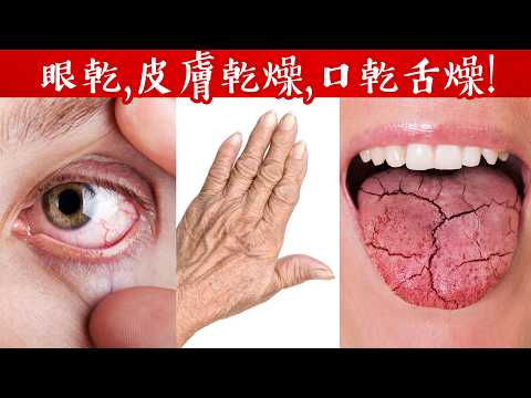 皮膚乾燥、眼乾、口乾舌燥的最佳療法,柏格醫生 Dr Berg