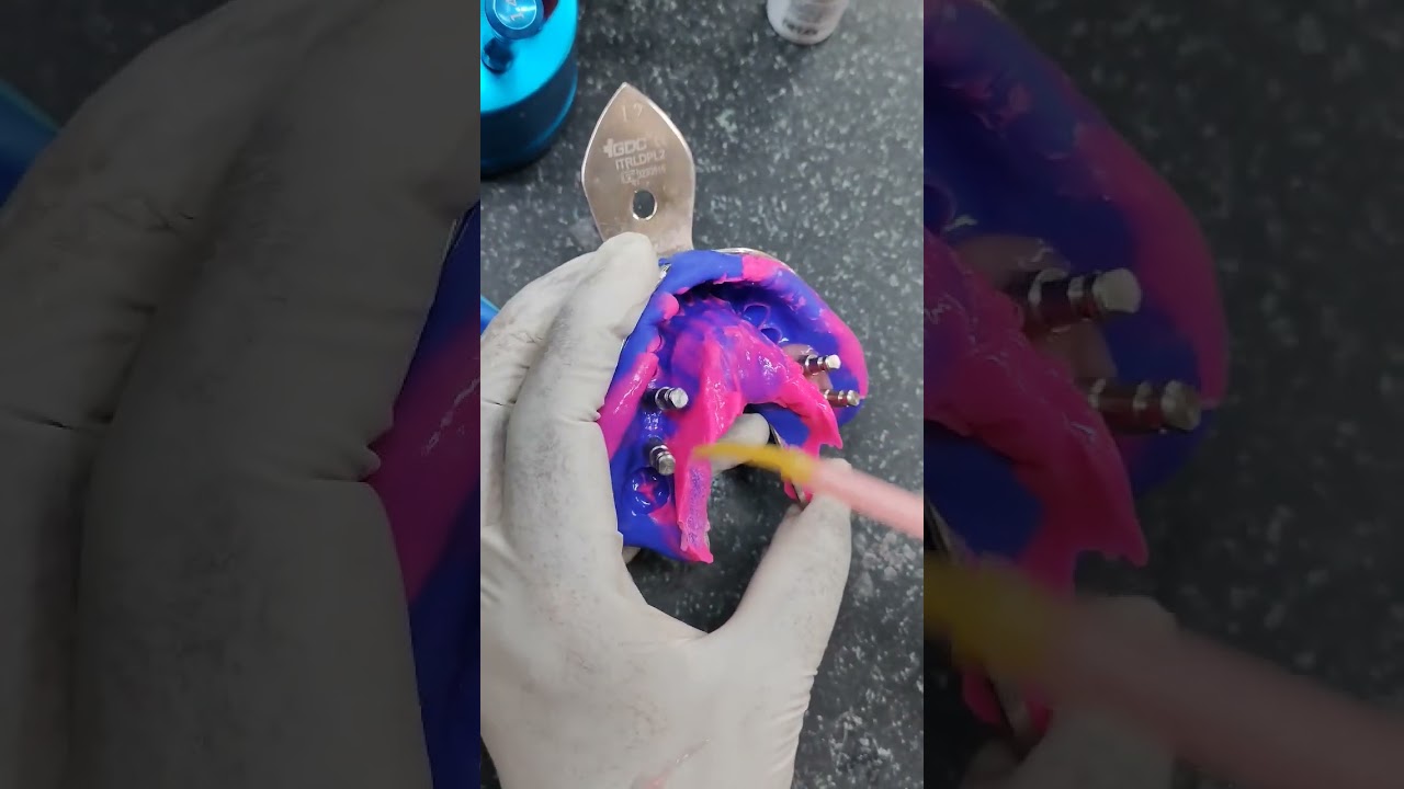 gingival mask#implantdentist #dentalimplantology #analog