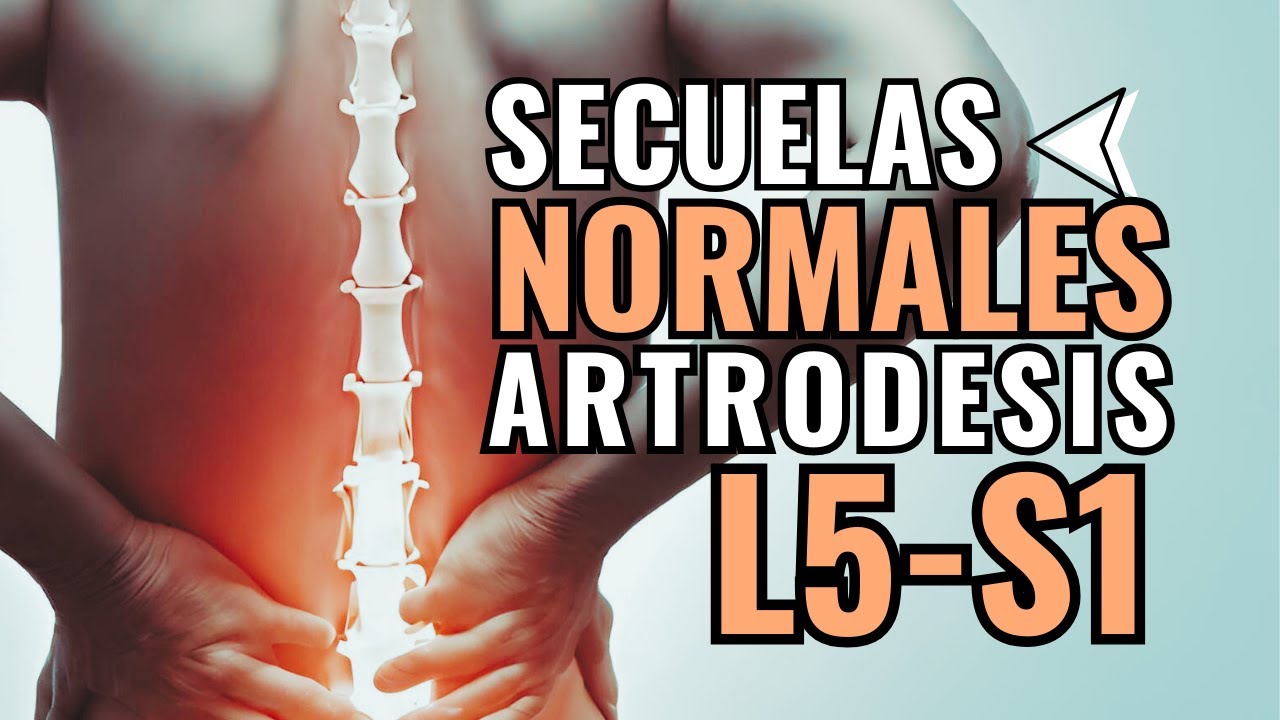 🔴 ¿Cuáles son las SECUELAS de la ARTRODESIS L5-S1? Sin Miedo ante la CIRUGÍA Lumbar