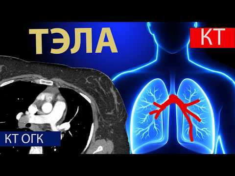 Лучевая диагностика ТЭЛА