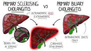 Primary Sclerosing Cholangitis | Visual Explanation for Students | Drk