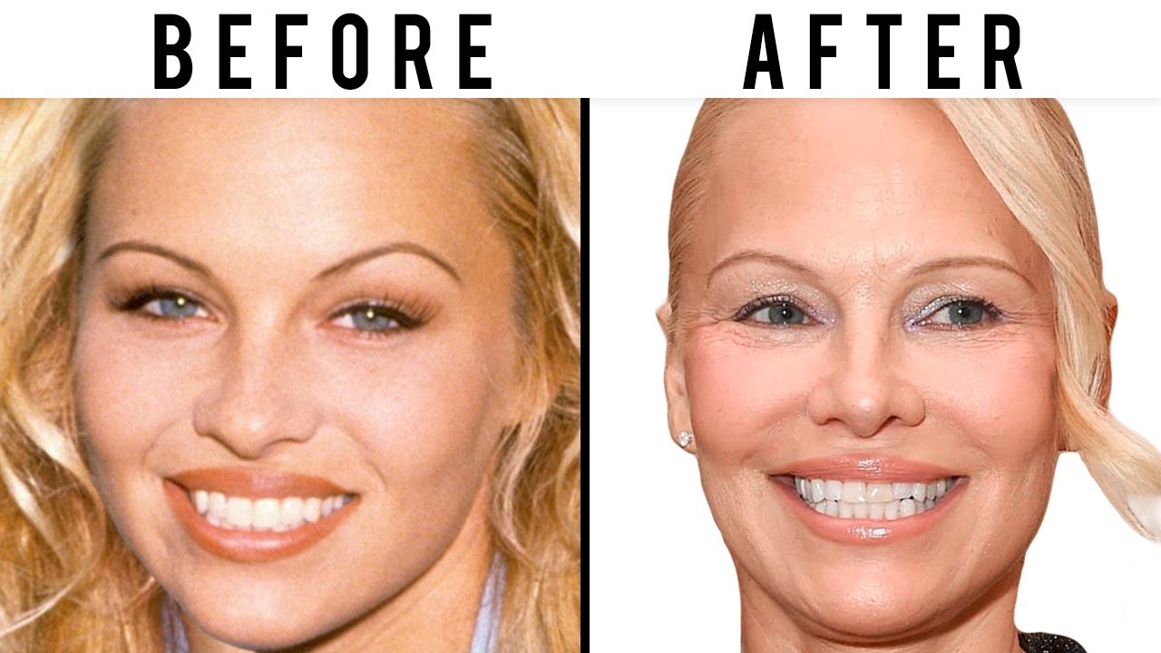 Has Pamela Anderson Had Plastic Surgery? | Plastic Surgery Analysis
