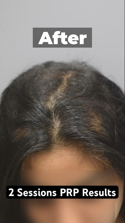 PRP Results Before & After 2 Sessions  #prptreatment #hairlosstreatment
