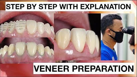 Step by Step Minimally Invasive Veneers Preparation | General Dentist Griya RR