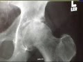 Diagnosing an Arthritic Hip Joint