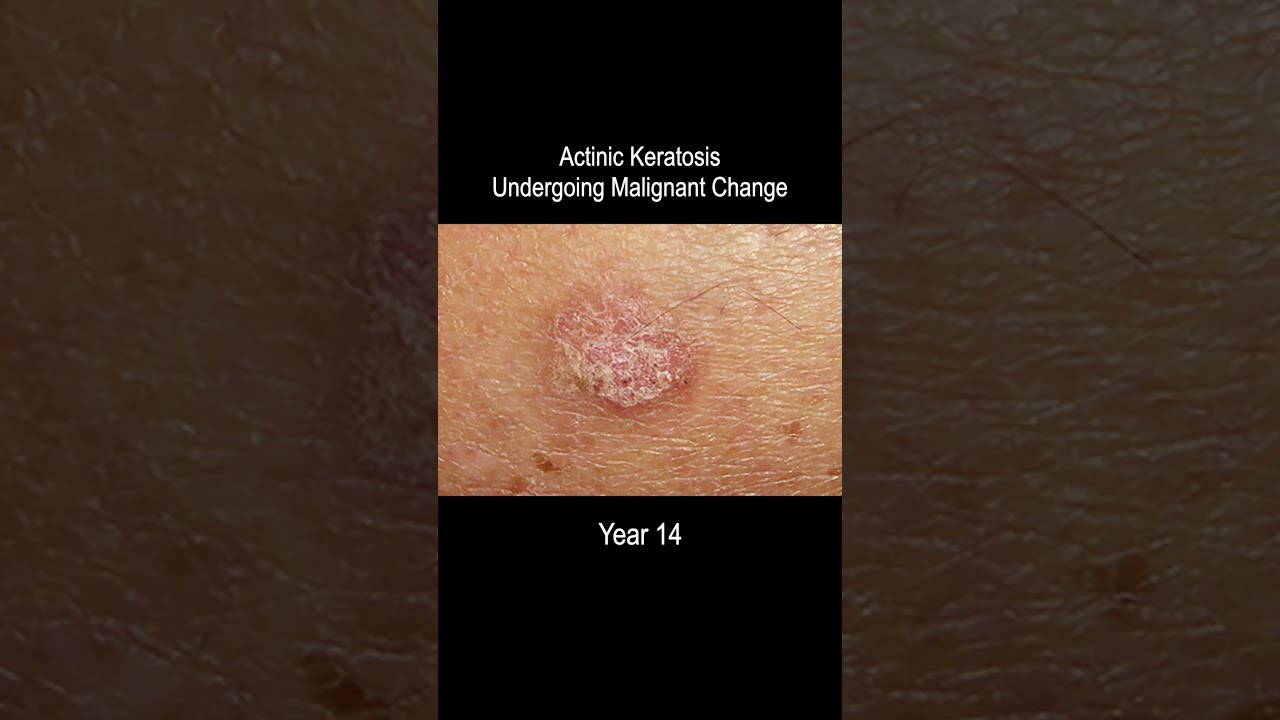 Skin Cancer Development Time Lapse Normal To Squamous Cell Carcinoma Over 25 Years 