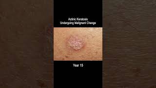 Skin Cancer Development Time Lapse (Normal to Squamous Cell Carcinoma Over 25 Years)