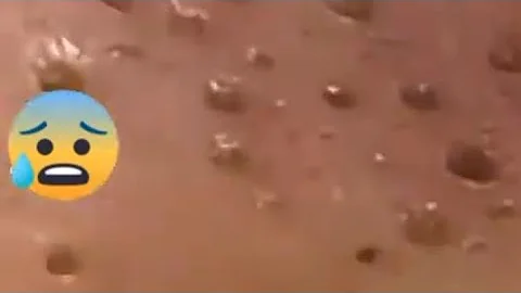 How to remove blackheads around the nose #blackheadremoval #oddlysatisfying #blackhead #pimplepoppin