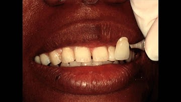 Lecture, Time Saving Light-Cured Composite Veneer Technique