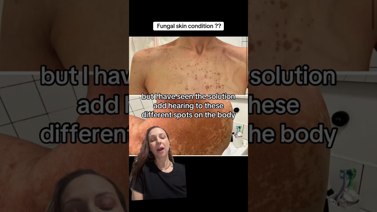 Uneven Tan Patches? It Might Be Tinea Versicolor | Tips for Spray Tan Artists 🎨✨